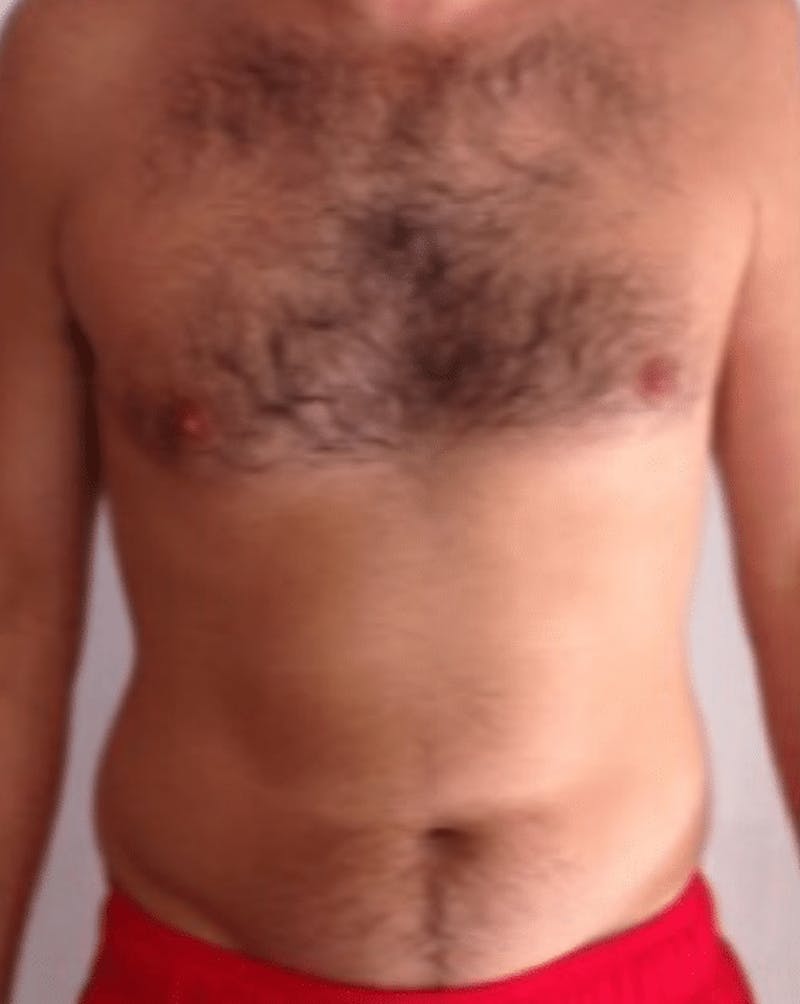 High Definition Liposuction Before & After Gallery - Patient 329601 - Image 1