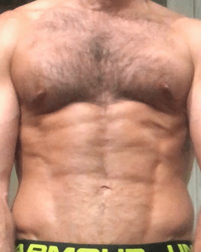 High Definition Liposuction Before & After Gallery - Patient 329601 - Image 2