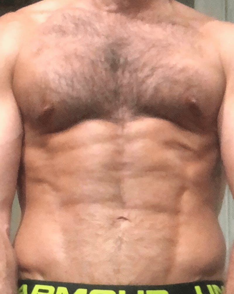 High Definition Liposuction Before & After Gallery - Patient 329601 - Image 2