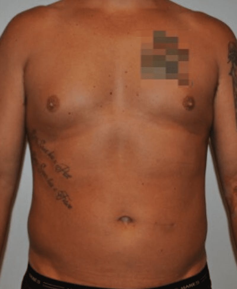 High Definition Liposuction Before & After Gallery - Patient 195956 - Image 1