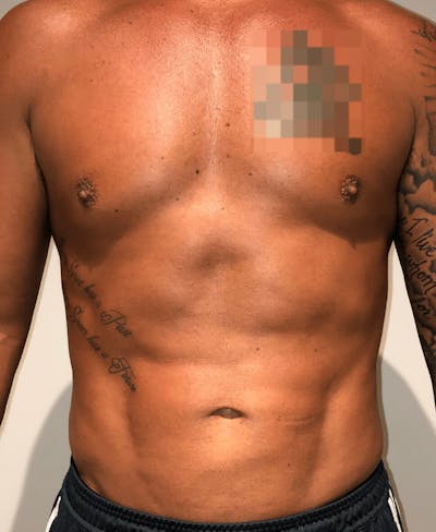 High Definition Liposuction Before & After Gallery - Patient 195956 - Image 2