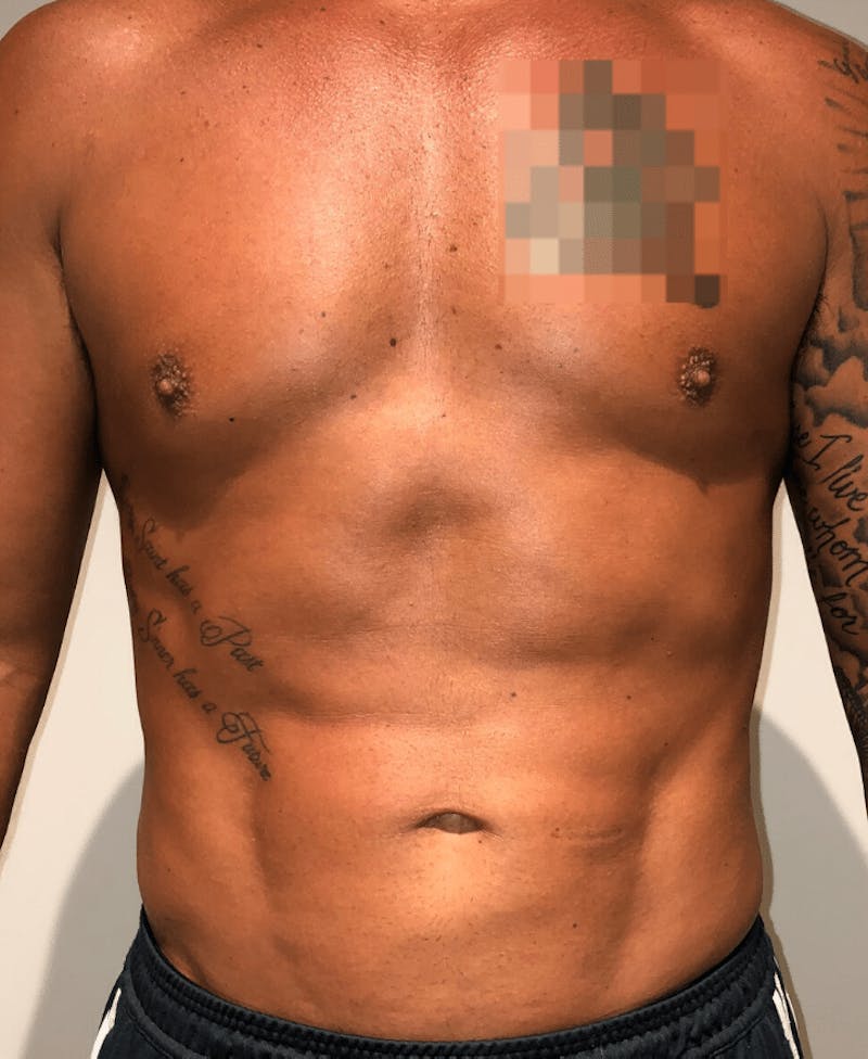 High Definition Liposuction Before & After Gallery - Patient 195956 - Image 2