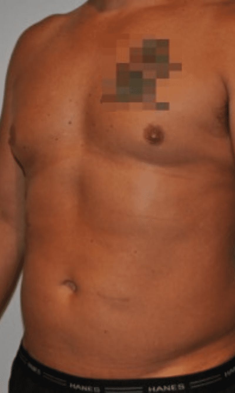 High Definition Liposuction Before & After Gallery - Patient 195956 - Image 3