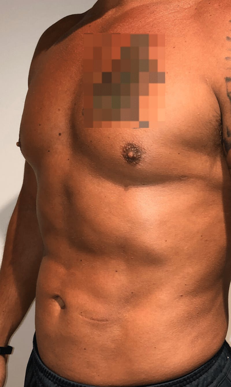 High Definition Liposuction Before & After Gallery - Patient 195956 - Image 4