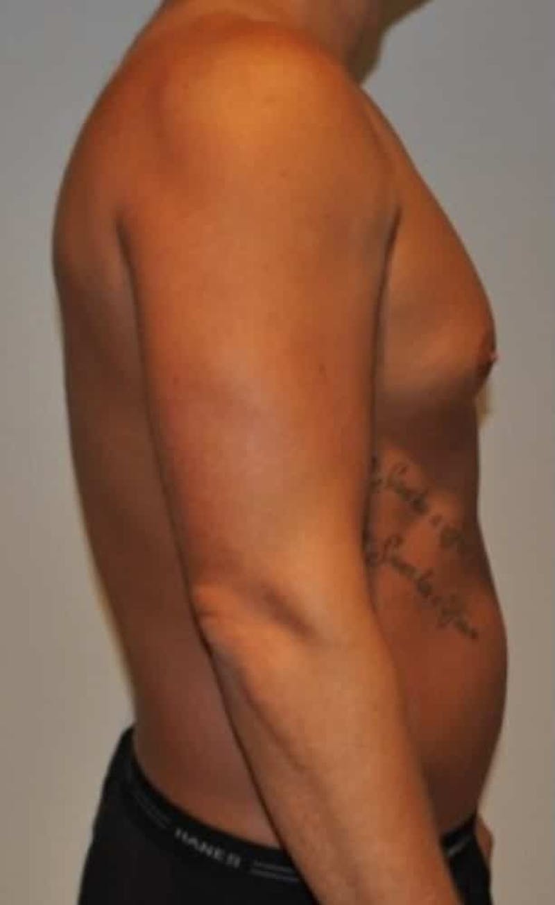 High Definition Liposuction Before & After Gallery - Patient 195956 - Image 5