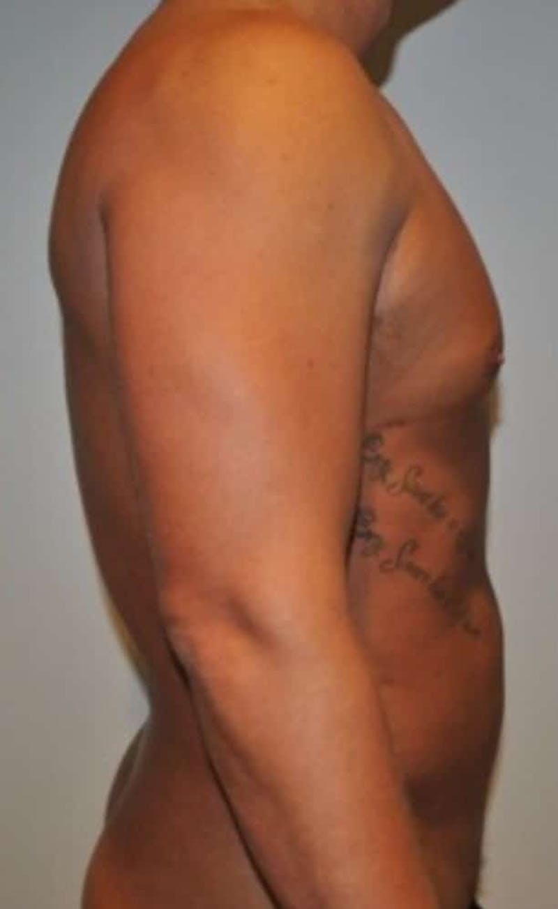 High Definition Liposuction Before & After Gallery - Patient 195956 - Image 6