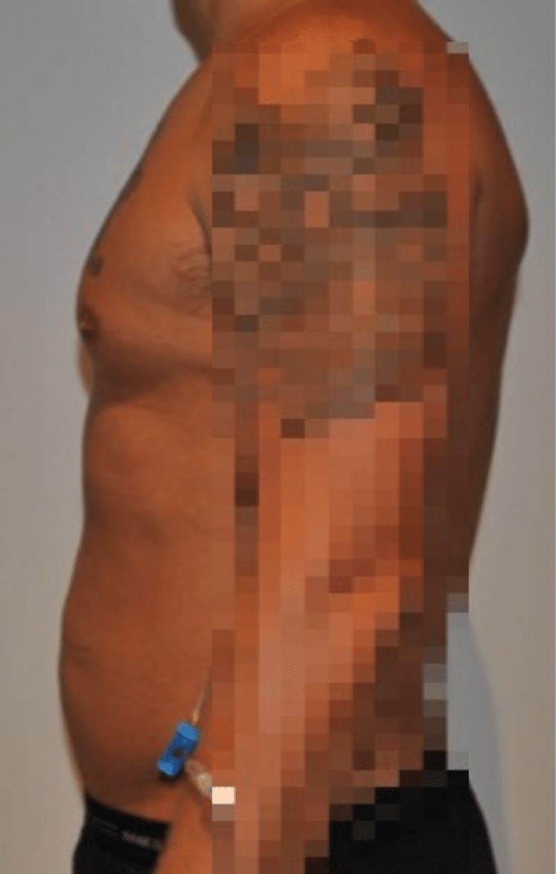 High Definition Liposuction Before & After Gallery - Patient 195956 - Image 7