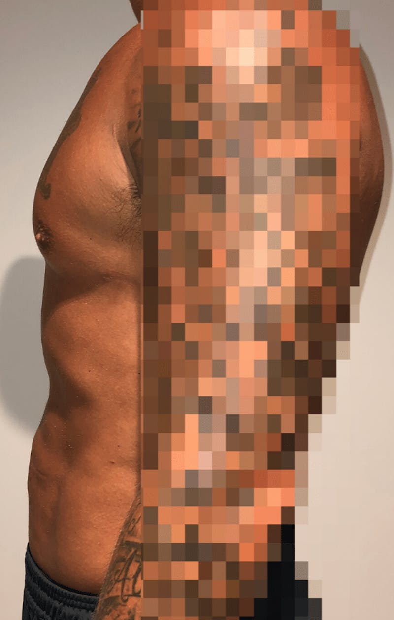 High Definition Liposuction Before & After Gallery - Patient 195956 - Image 8