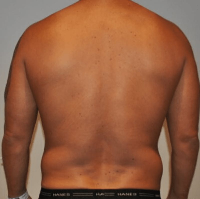 High Definition Liposuction Before & After Gallery - Patient 195956 - Image 9