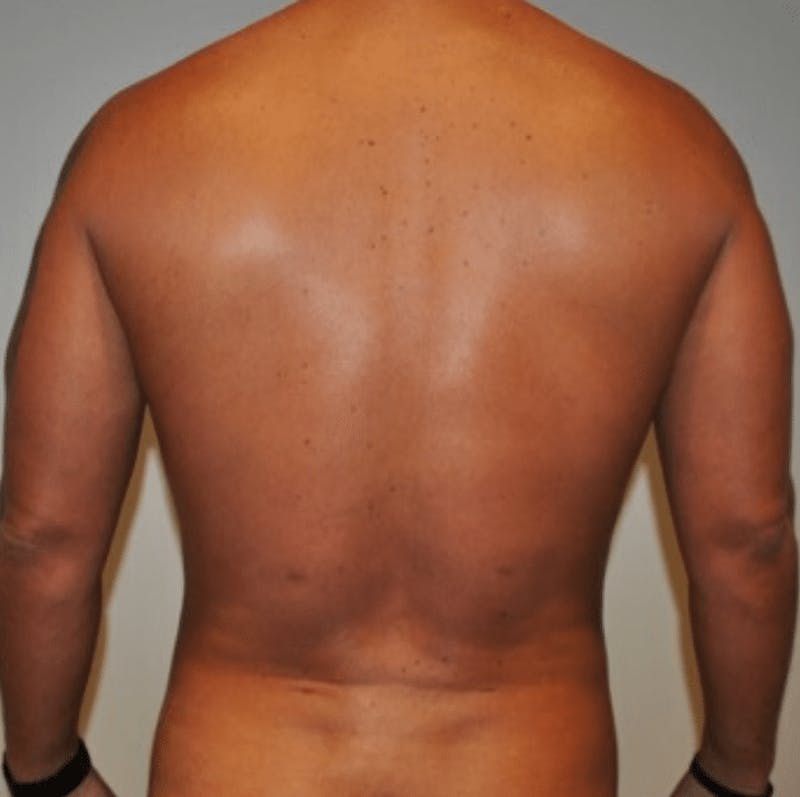 High Definition Liposuction Before & After Gallery - Patient 195956 - Image 10