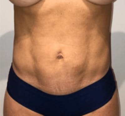 High Definition Liposuction Before & After Gallery - Patient 264725 - Image 2