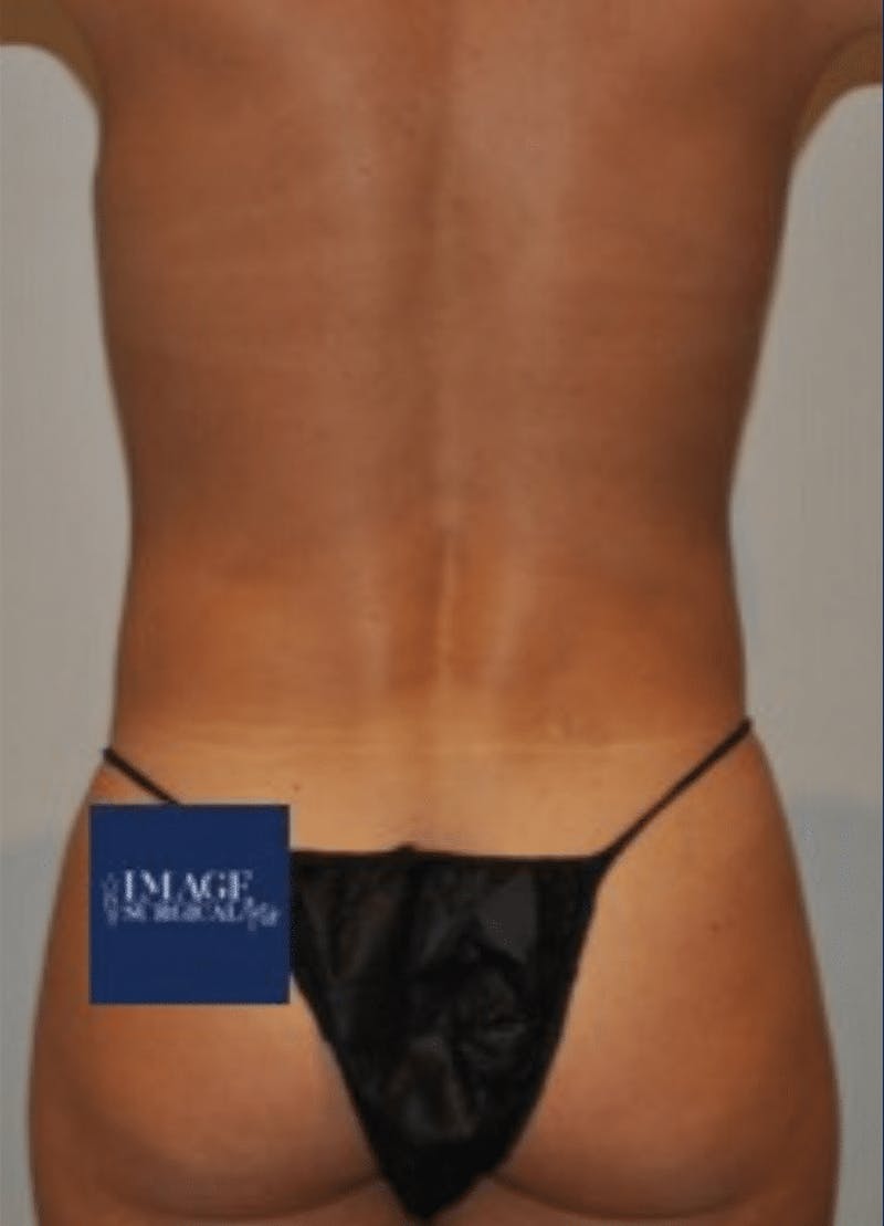 High Definition Liposuction Before & After Gallery - Patient 264725 - Image 3