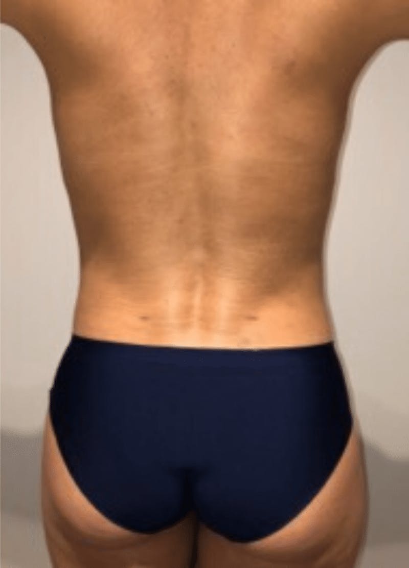 High Definition Liposuction Before & After Gallery - Patient 264725 - Image 4