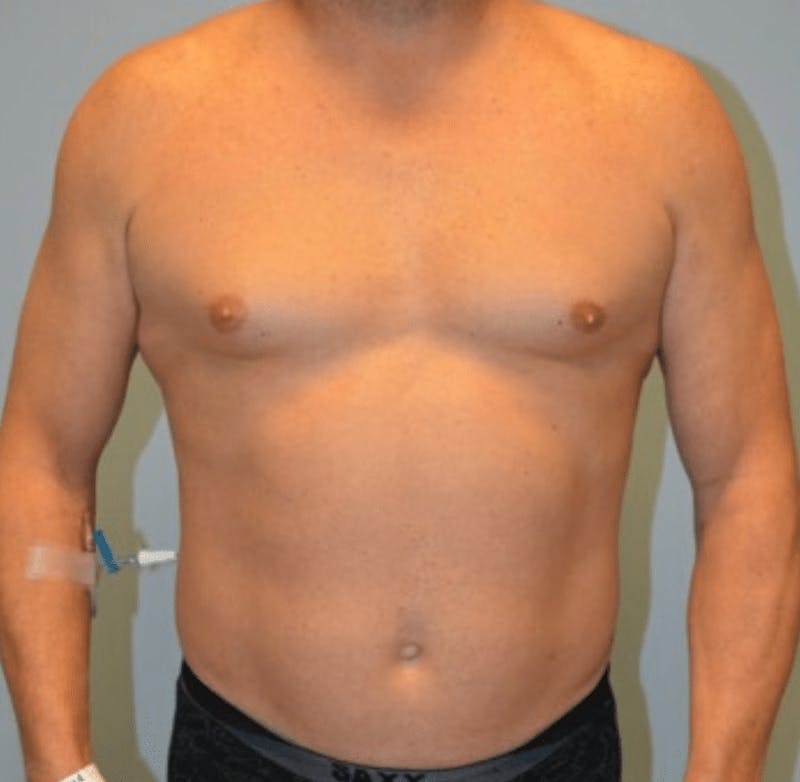 High Definition Liposuction Before & After Gallery - Patient 169908 - Image 1
