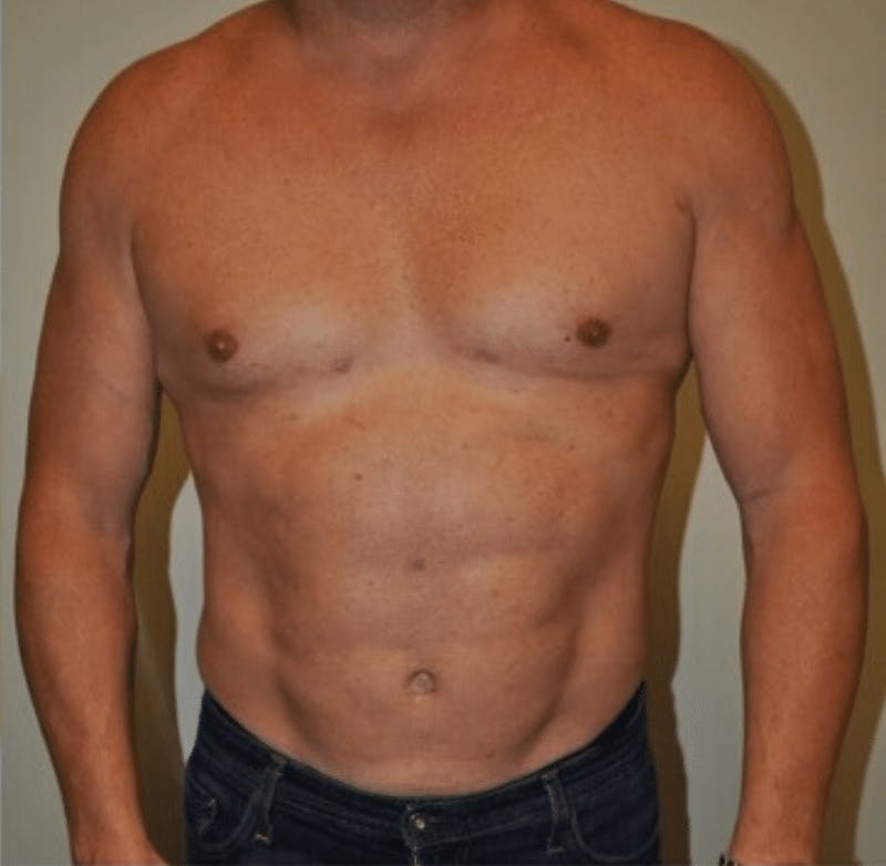High Definition Liposuction Before & After Gallery - Patient 169908 - Image 2