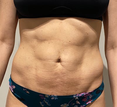 High Definition Liposuction Before & After Gallery - Patient 399397 - Image 2