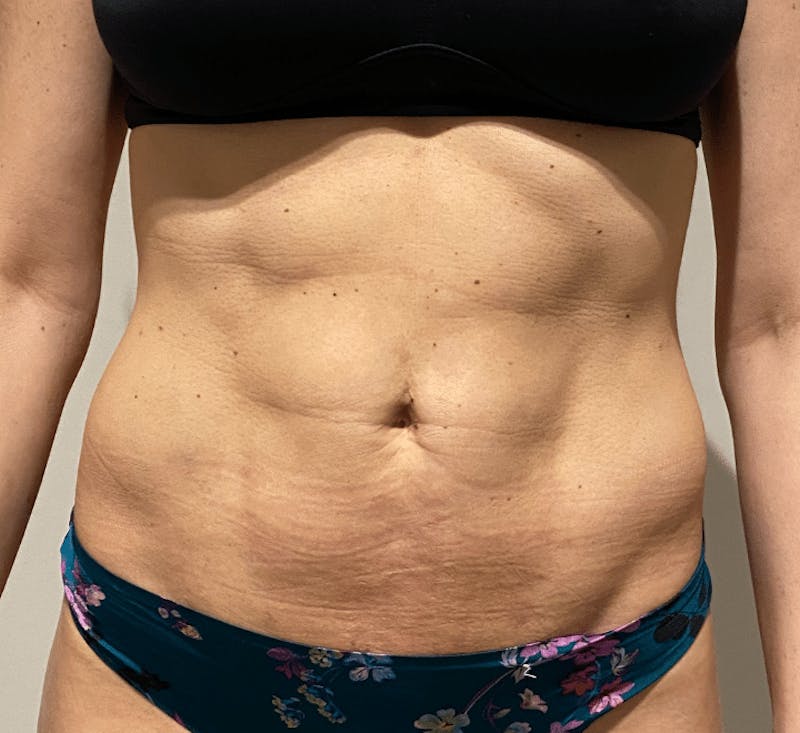 High Definition Liposuction Before & After Gallery - Patient 399397 - Image 2