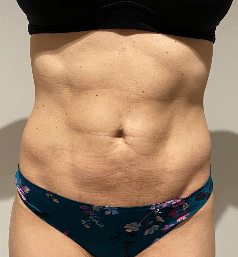 High Definition Liposuction Before & After Gallery - Patient 399397 - Image 4