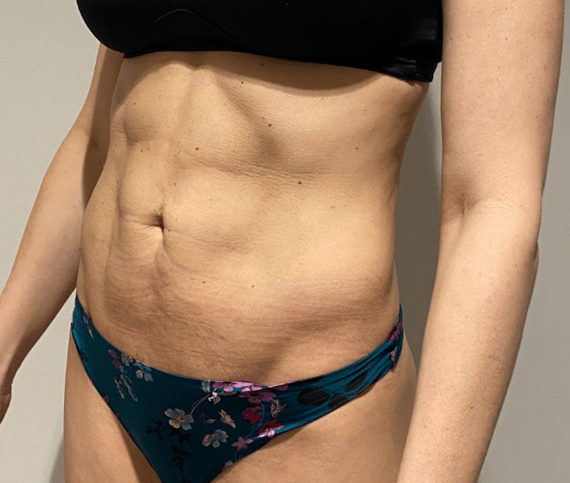 High Definition Liposuction Before & After Gallery - Patient 399397 - Image 6
