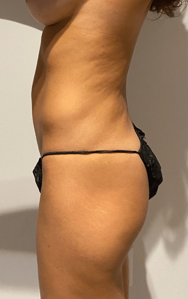 High Definition Liposuction Before & After Gallery - Patient 399397 - Image 7