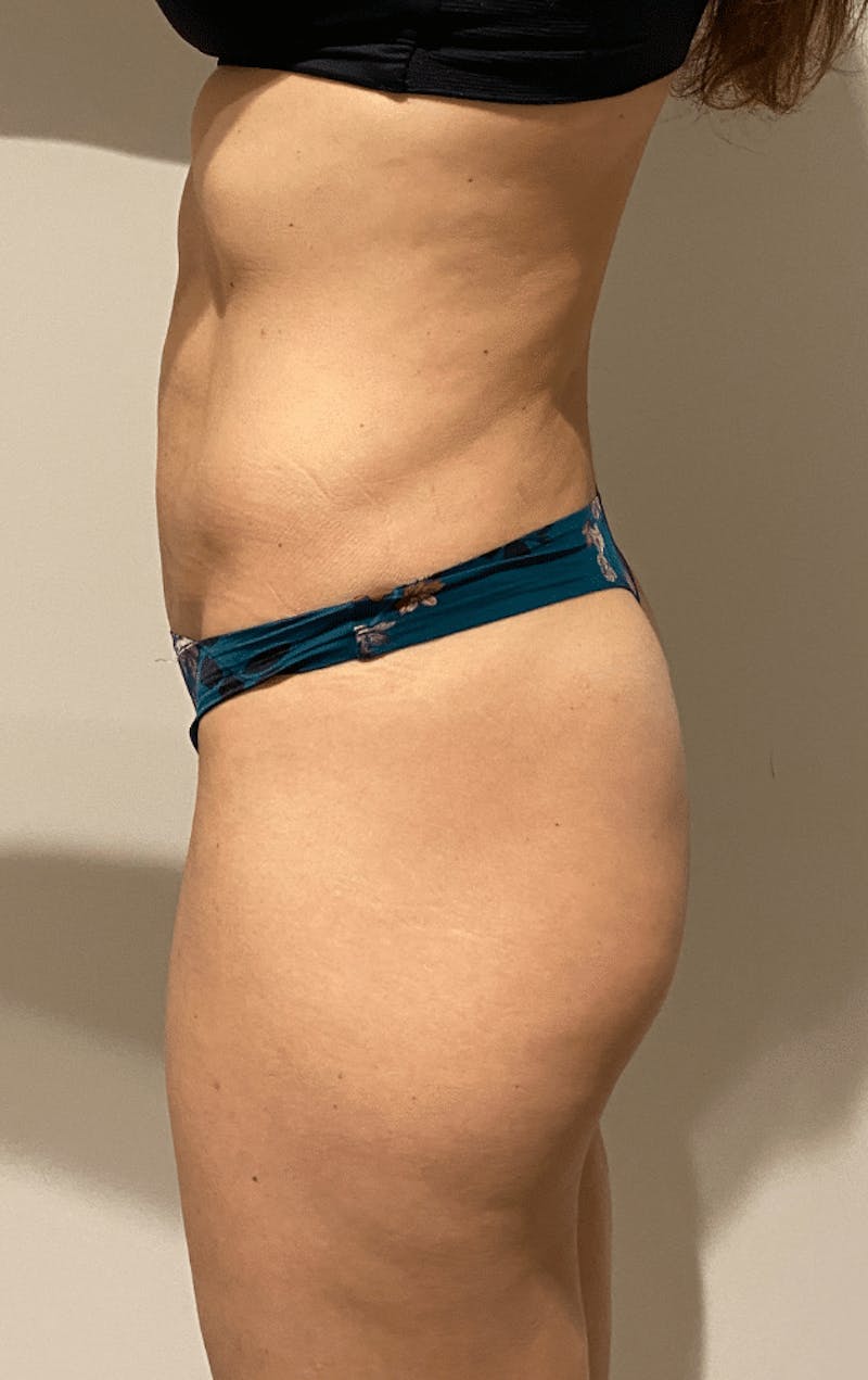 High Definition Liposuction Before & After Gallery - Patient 399397 - Image 8