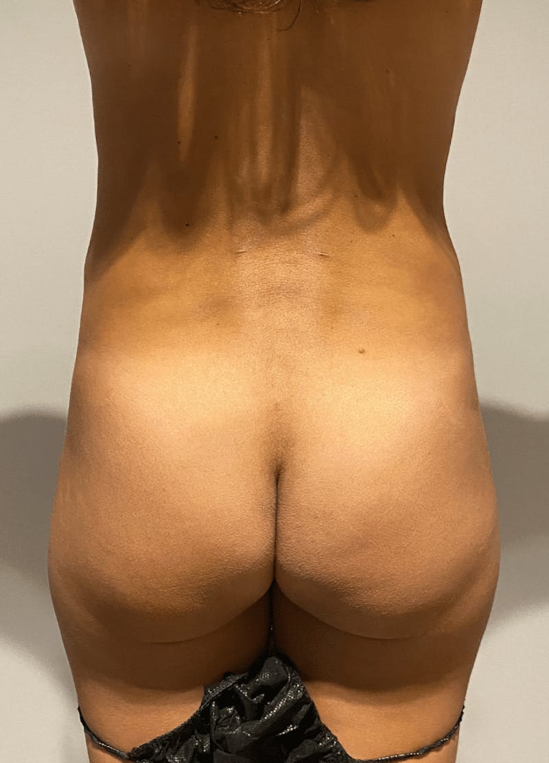 High Definition Liposuction Before & After Gallery - Patient 399397 - Image 11