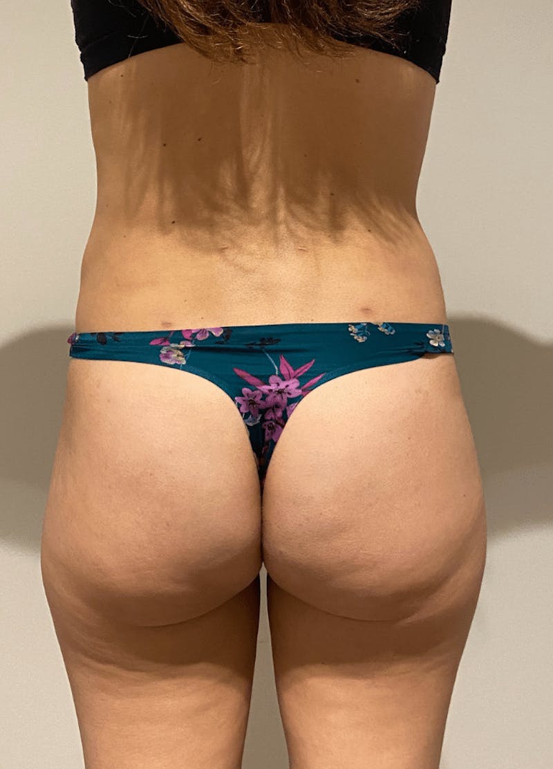 High Definition Liposuction Before & After Gallery - Patient 399397 - Image 12