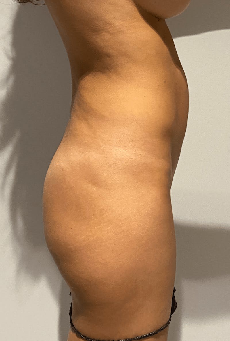 High Definition Liposuction Before & After Gallery - Patient 399397 - Image 13