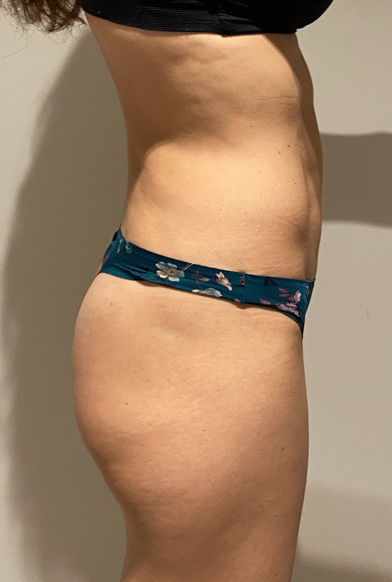 High Definition Liposuction Before & After Gallery - Patient 399397 - Image 14