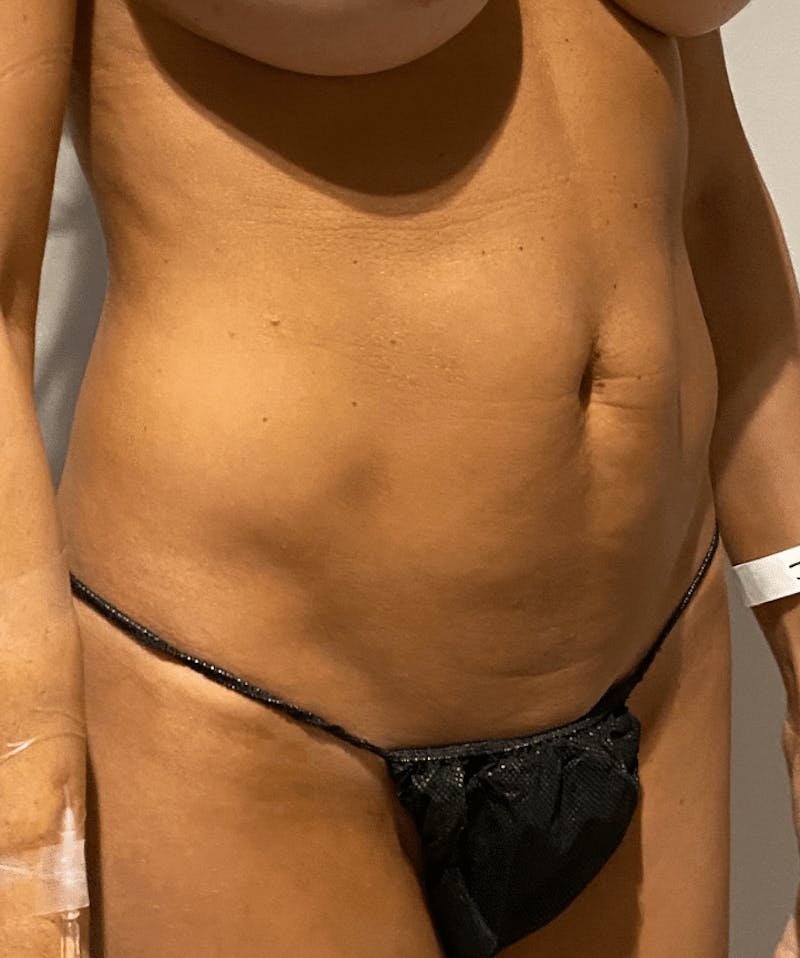 High Definition Liposuction Before & After Gallery - Patient 399397 - Image 15