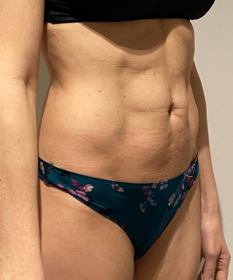 High Definition Liposuction Before & After Gallery - Patient 399397 - Image 16