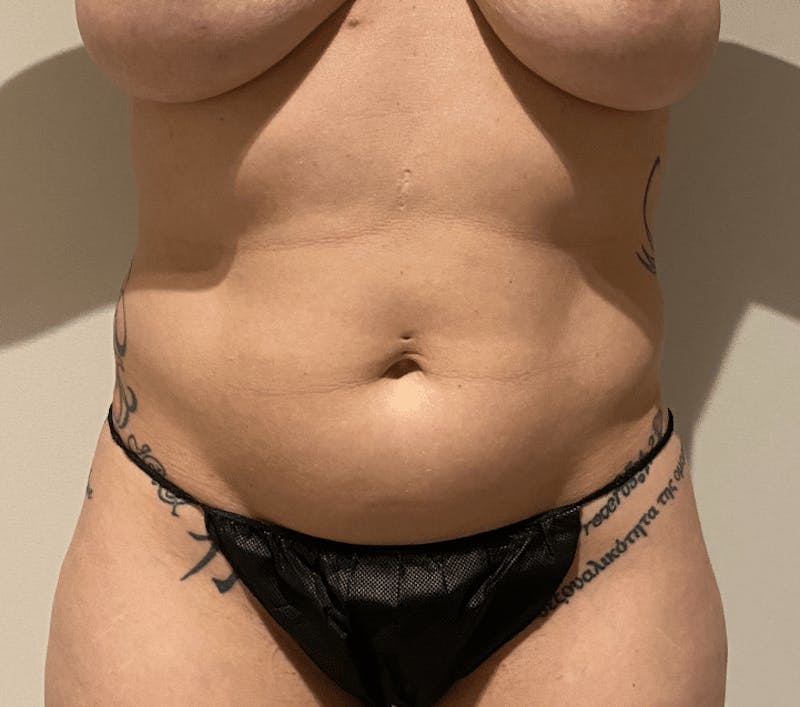 High Definition Liposuction Before & After Gallery - Patient 380428 - Image 1