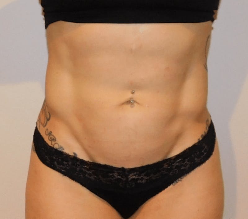 High Definition Liposuction Before & After Gallery - Patient 380428 - Image 2