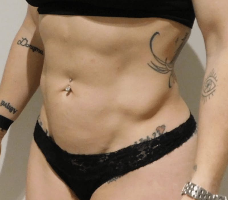 High Definition Liposuction Before & After Gallery - Patient 380428 - Image 4
