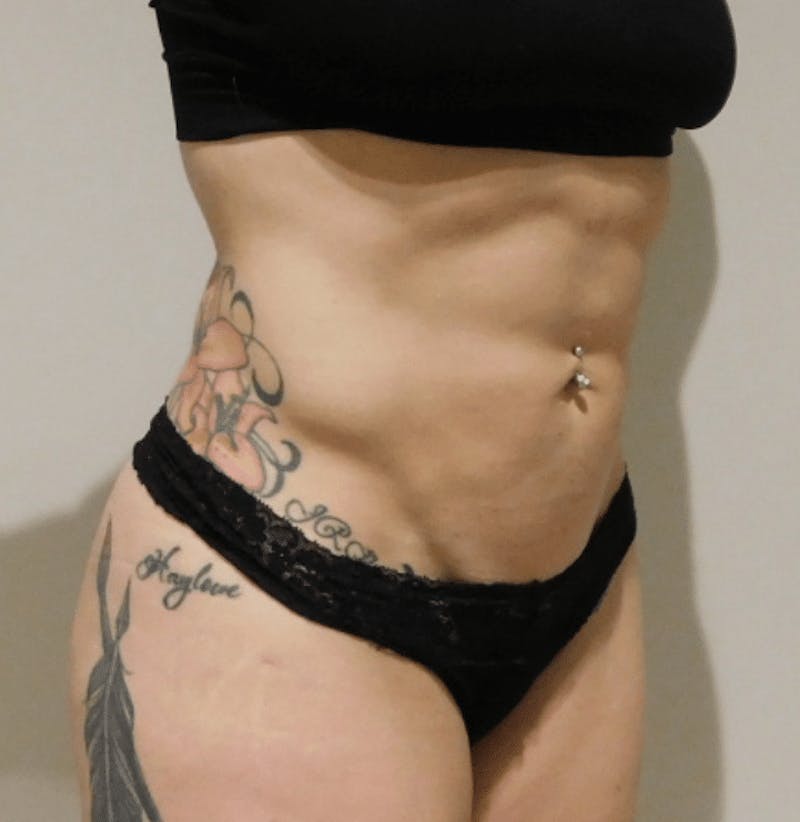 High Definition Liposuction Before & After Gallery - Patient 380428 - Image 6