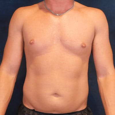 High Definition Liposuction Before & After Gallery - Patient 213865 - Image 1