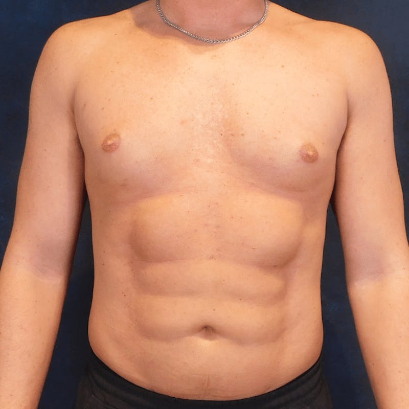 High Definition Liposuction Before & After Gallery - Patient 213865 - Image 2