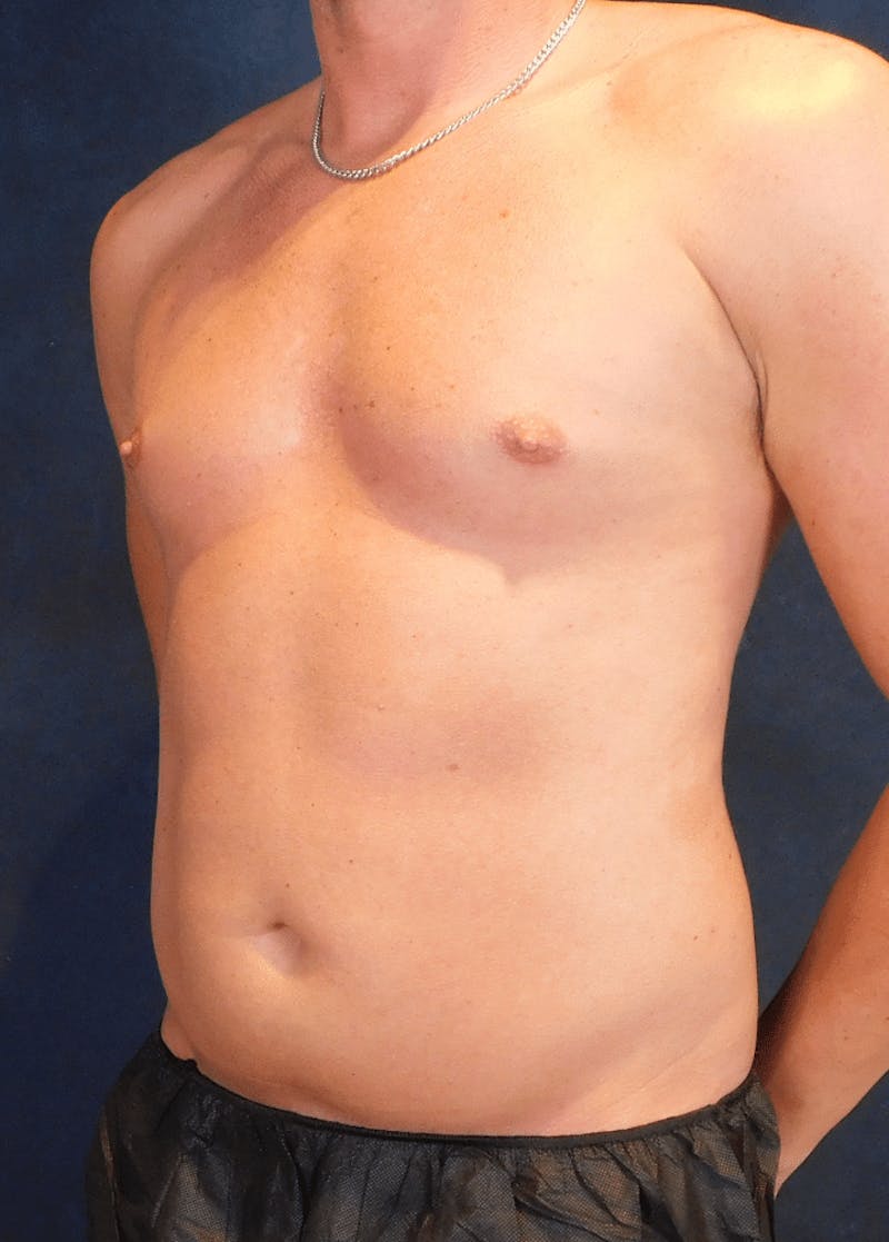 High Definition Liposuction Before & After Gallery - Patient 213865 - Image 3