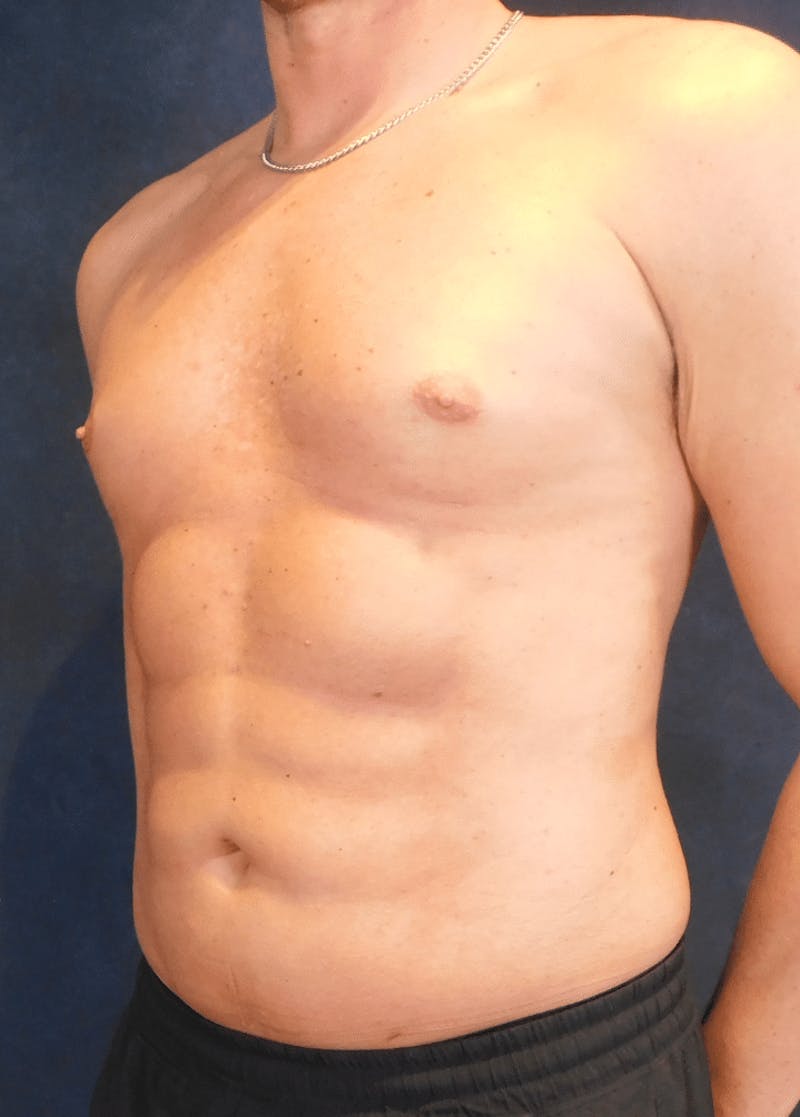 High Definition Liposuction Before & After Gallery - Patient 213865 - Image 4