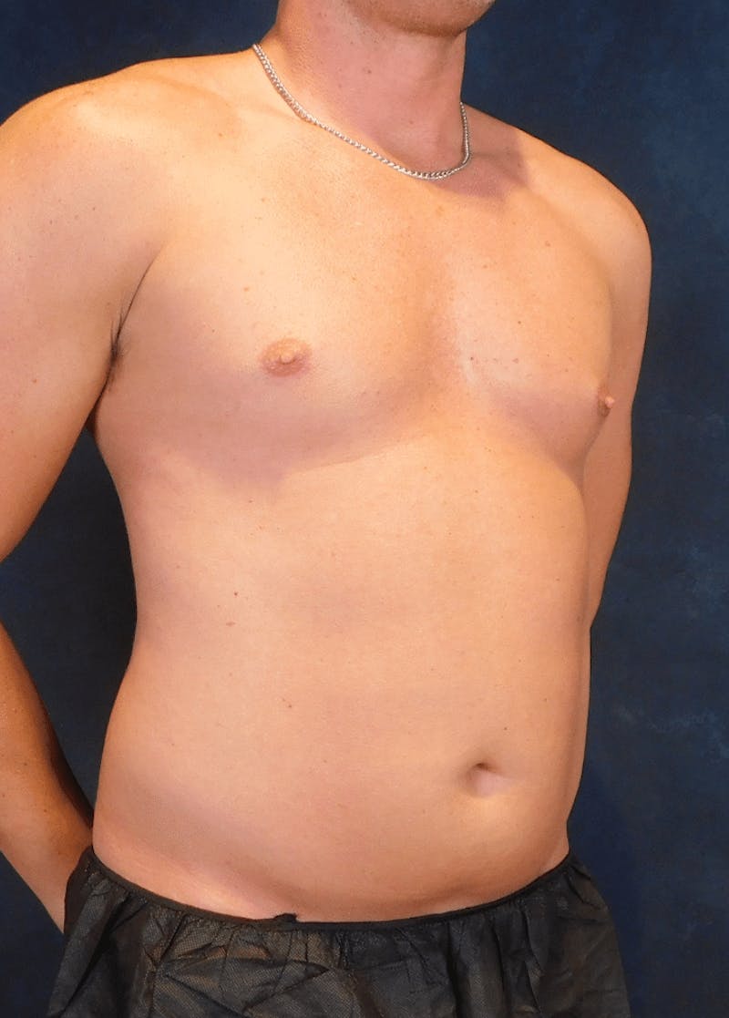 High Definition Liposuction Before & After Gallery - Patient 213865 - Image 5