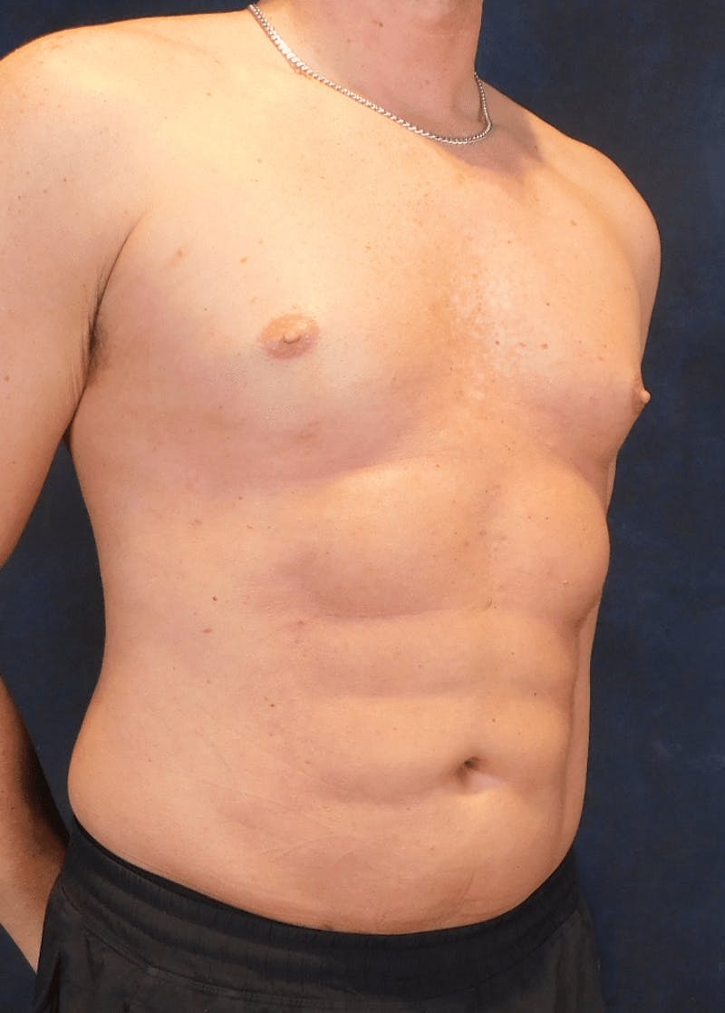High Definition Liposuction Before & After Gallery - Patient 213865 - Image 6