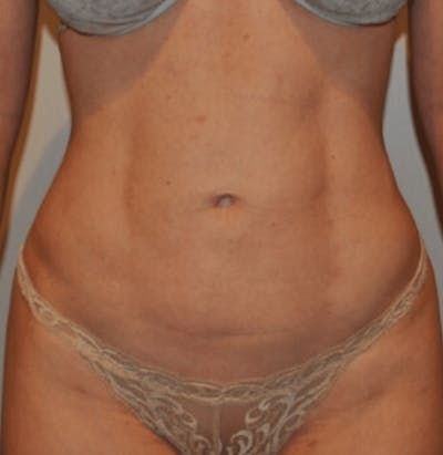 Liposuction Before & After Gallery - Patient 341560 - Image 2
