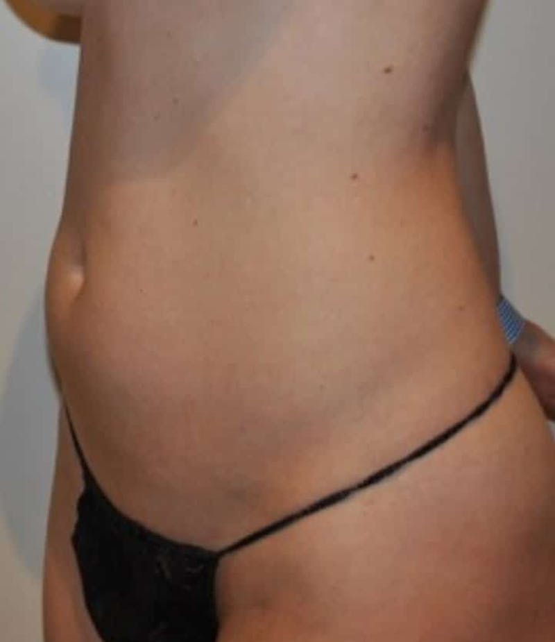 Liposuction Before & After Gallery - Patient 341560 - Image 5