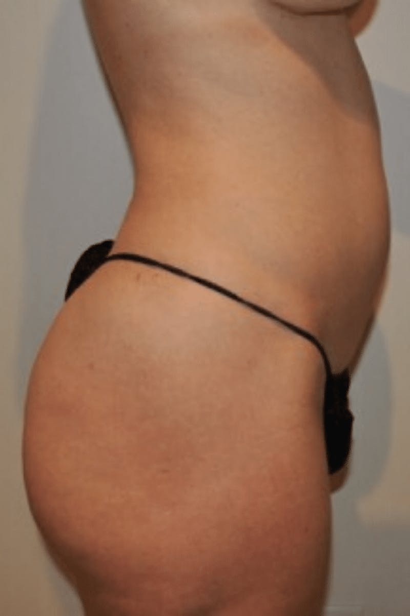 Liposuction Before & After Gallery - Patient 341560 - Image 7
