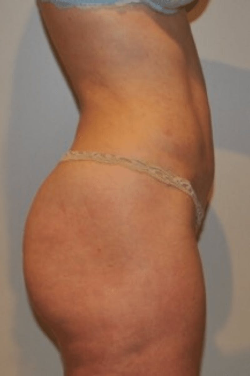Liposuction Before & After Gallery - Patient 341560 - Image 8