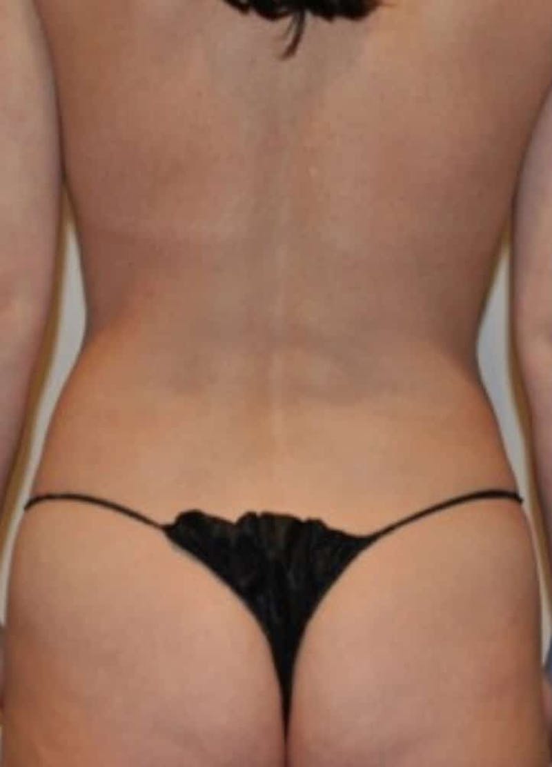 Liposuction Before & After Gallery - Patient 341560 - Image 9