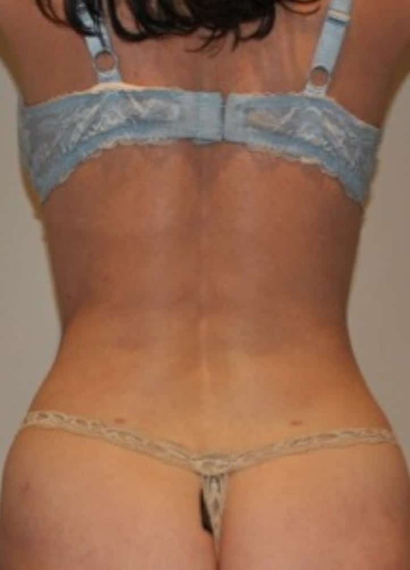 Liposuction Before & After Gallery - Patient 341560 - Image 10