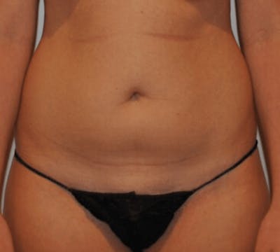 Liposuction Before & After Gallery - Patient 237448 - Image 1