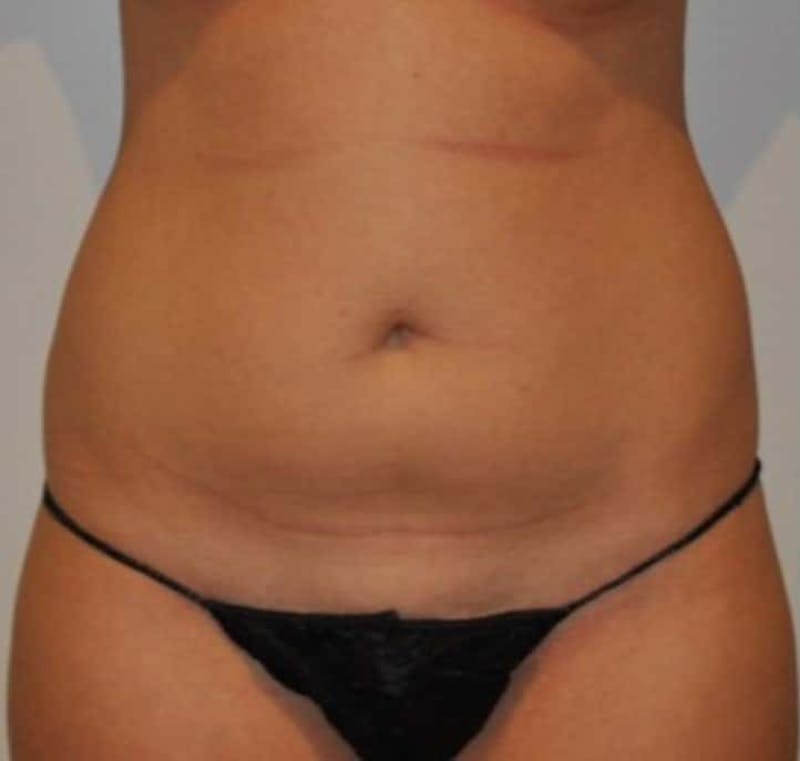 Liposuction Before & After Gallery - Patient 237448 - Image 3