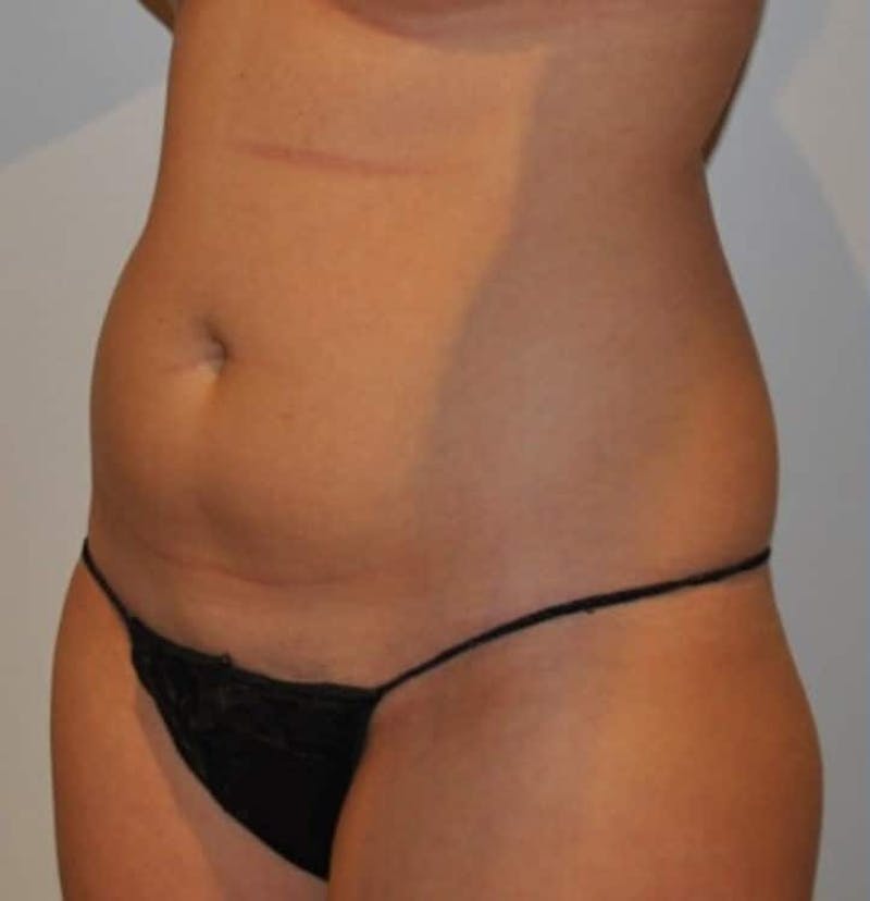 Liposuction Before & After Gallery - Patient 237448 - Image 5